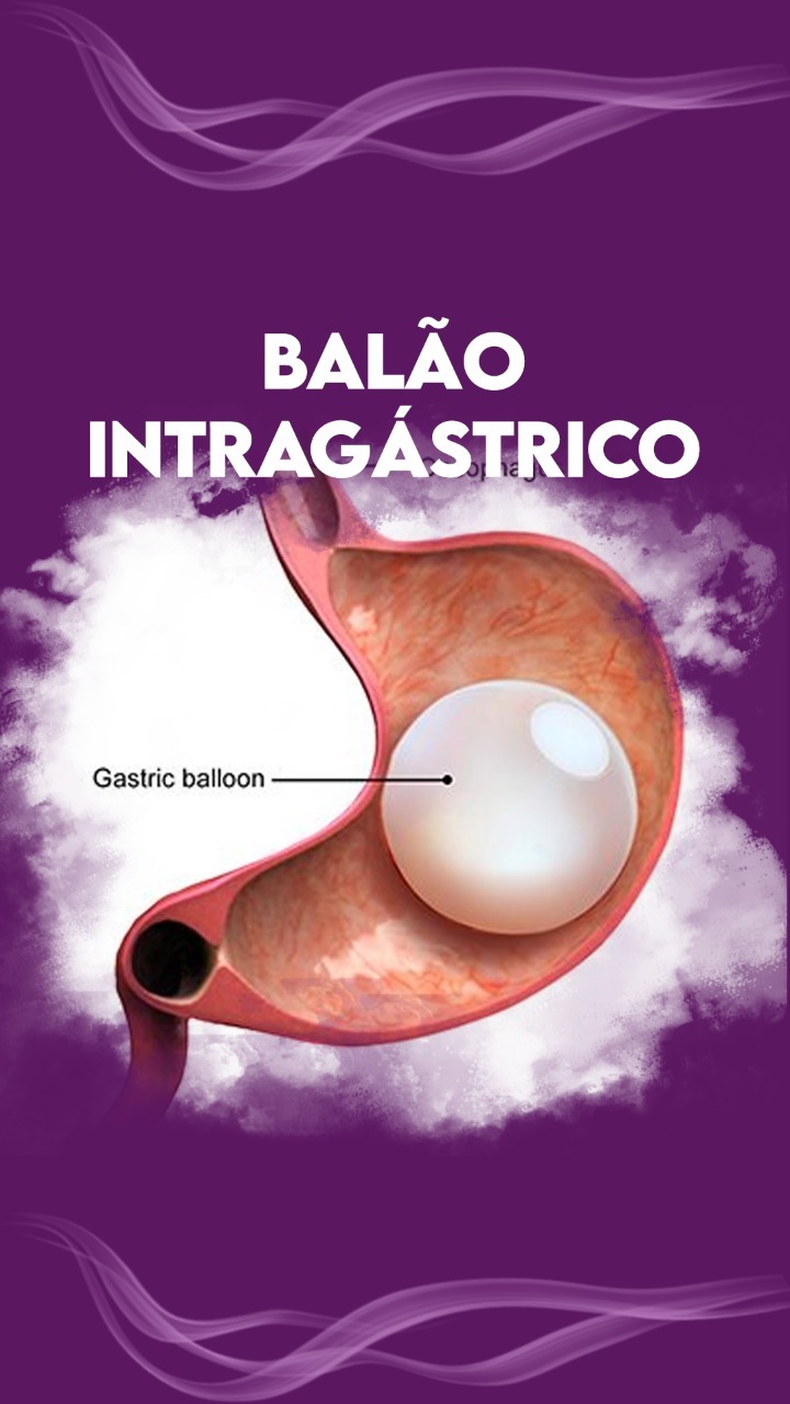 Tipos de balão intragástrico e como eles funcionam